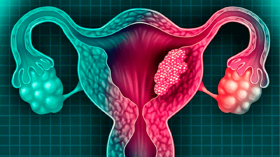 ¿Se puede eliminar el cáncer de cuello uterino?
